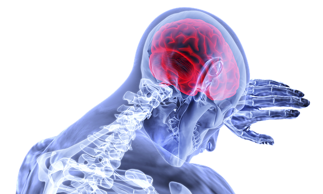 Free illustration: Brain, Inflammation, Stroke - Free Image on Pixabay - 3168269 (26233)